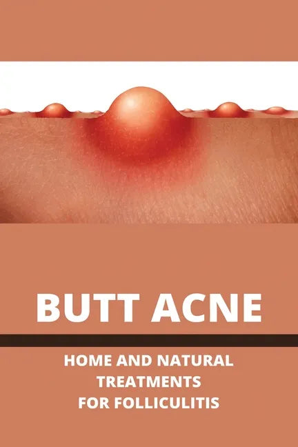 Butt Acne: Home And Natural Treatments For Folliculitis: Barber'S Itch Home Remedies - Paperback