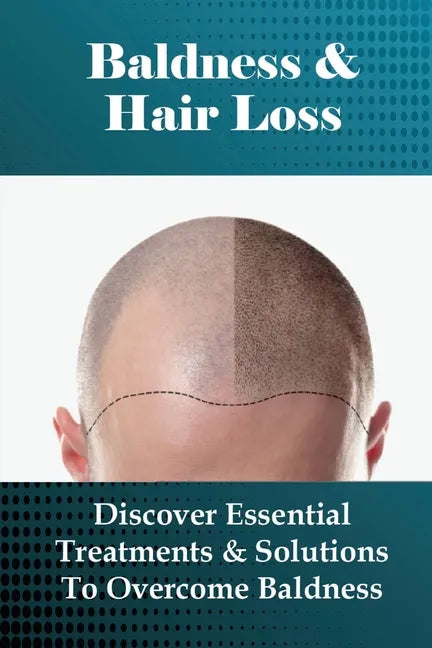 Baldness & Hair Loss: Discover Essential Treatments & Solutions To Overcome Baldness: How To Prevent Hair Loss For Guys - Paperback